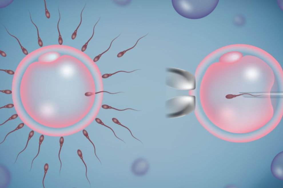 ICSI Treatment