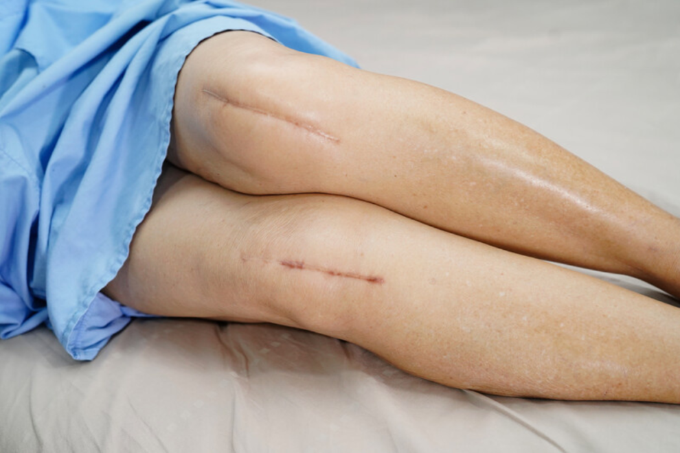 Unilateral Knee Replacement Surgery Unilateral Knee Replacement Surgery