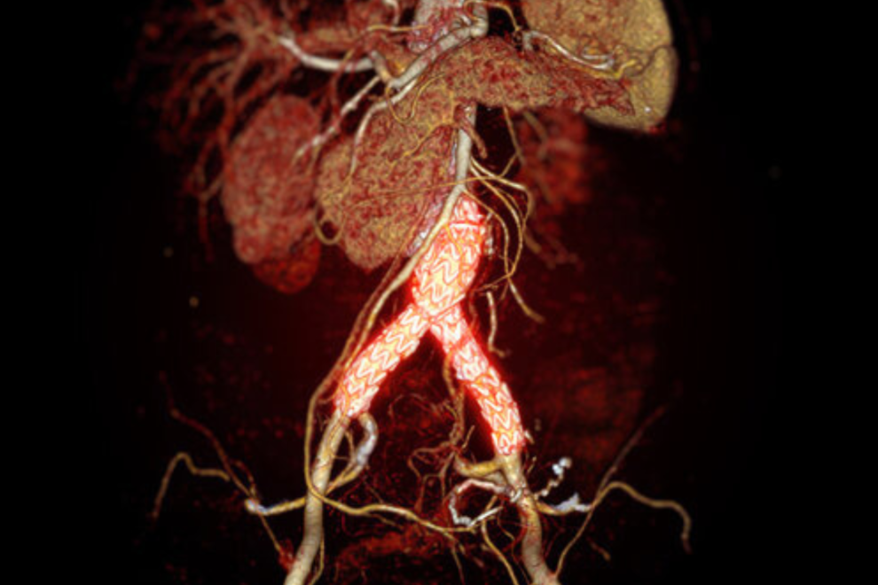 Abdominal Aortic Aneurysm in India Abdominal Aortic Aneurysm in India