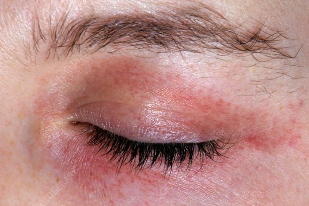 Amyloidosis Treatment Cost in India Amyloidosis Treatment Cost in India