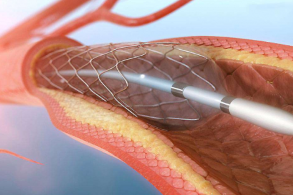 Angioplasty (PTCA)