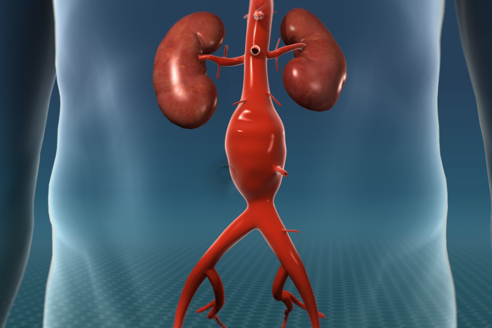 Aortic Aneurysm Repair Surgery Aortic Aneurysm Repair Surgery