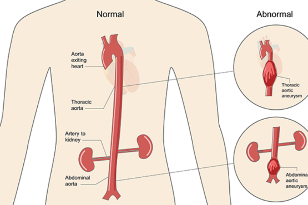Aortic Aneurysm Treatment in India Aortic Aneurysm Treatment in India