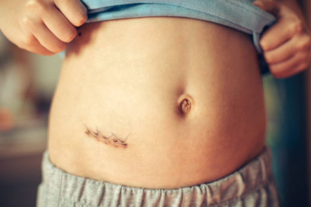 Appendicectomy Treatment Cost in India Appendicectomy Treatment Cost in India
