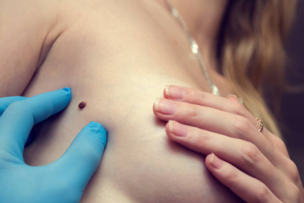 Birthmark Removal Birthmark Removal