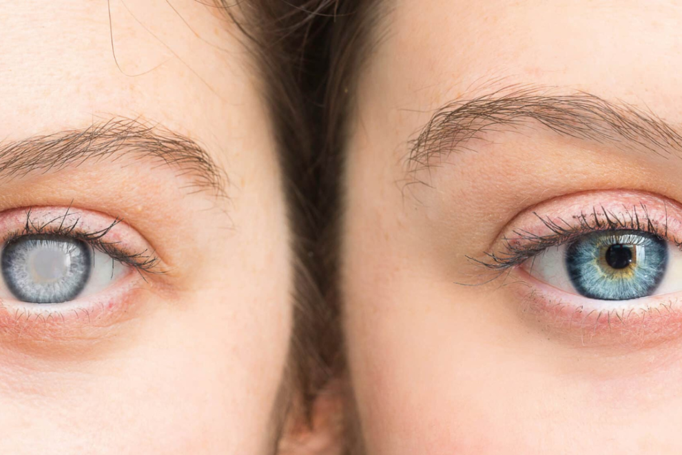 Cataract Surgery in India Cataract Surgery in India