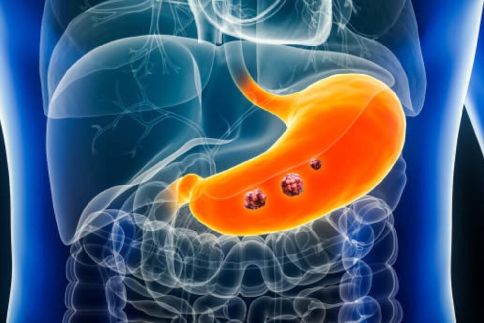 Comprehensive Gastroenterology Surgery Treatment in India: Advanced Solutions for Digestive Disorders Comprehensive Gastroenterology Surgery Treatment in India: Advanced Solutions for Digestive Disorders