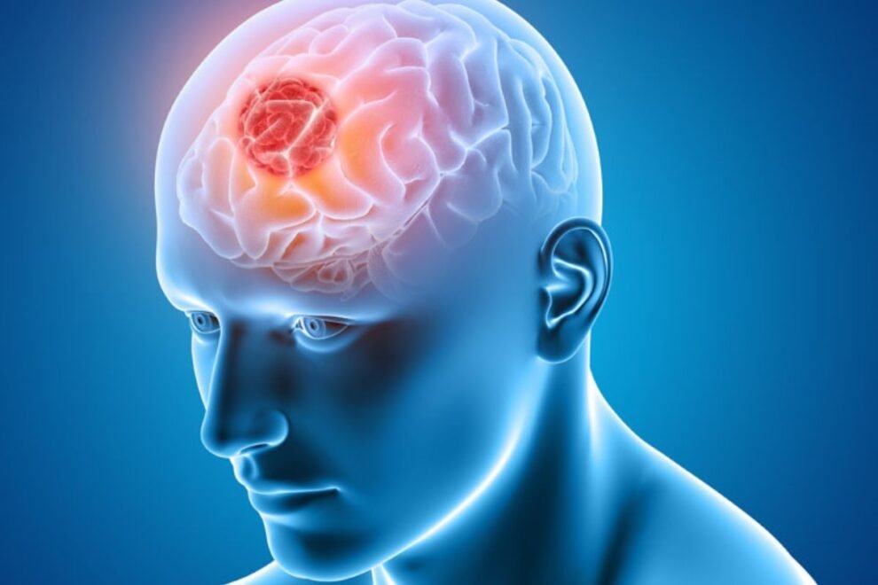 Gamma Knife Surgery in India Gamma Knife Surgery in India