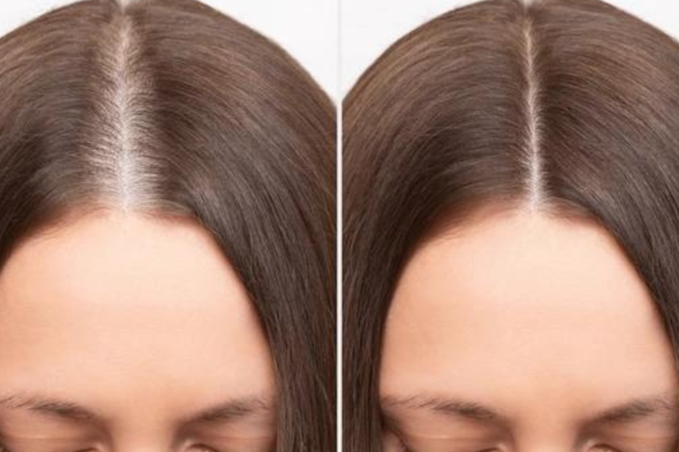 Hair Transplant in India