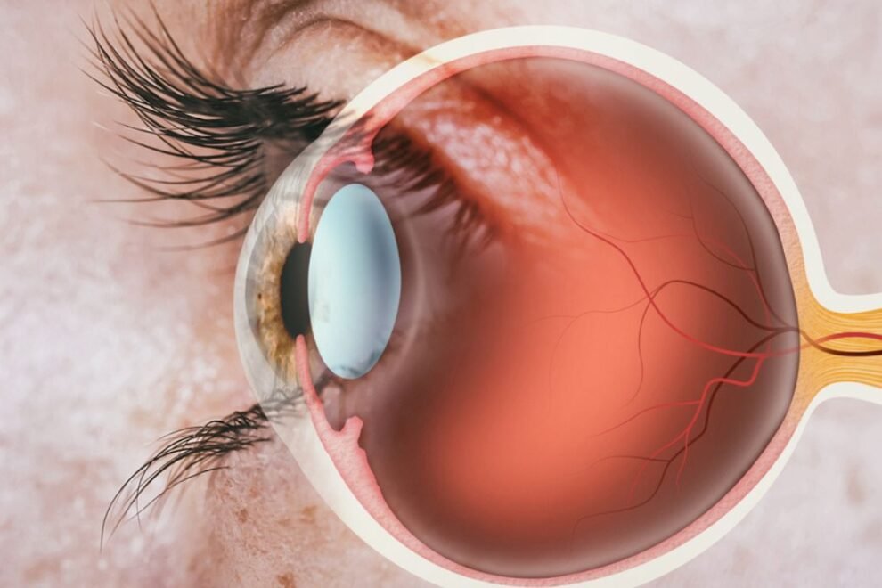 Retinal Detachment Surgery in India: Top Hospitals & Affordable Cost Retinal Detachment Surgery in India: Top Hospitals & Affordable Cost