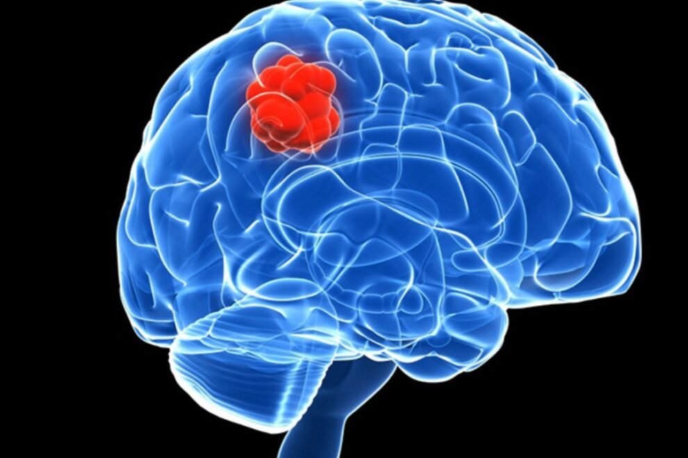 Schwannomas: Causes, Symptoms, and Treatment Options Schwannomas: Causes, Symptoms, and Treatment Options