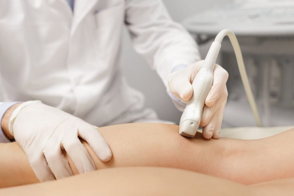 Sclerotherapy Varicose Veins Surgery: Procedure, Benefits & Aftercare Sclerotherapy Varicose Veins Surgery: Procedure, Benefits & Aftercare