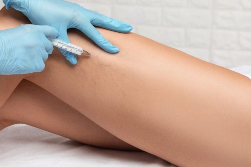 Sclerotherapy Varicose Veins Surgery in India: Cost, Benefits & Recovery Sclerotherapy Varicose Veins Surgery in India: Cost, Benefits & Recovery
