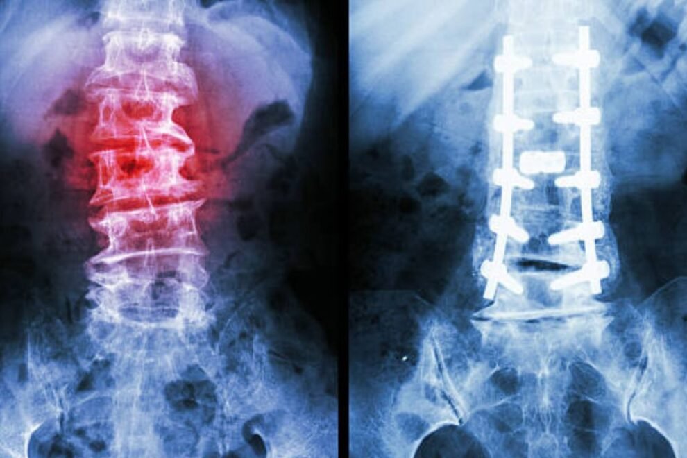Scoliosis Surgery: Types, Recovery, and Success Rates Explained Scoliosis Surgery: Types, Recovery, and Success Rates Explained
