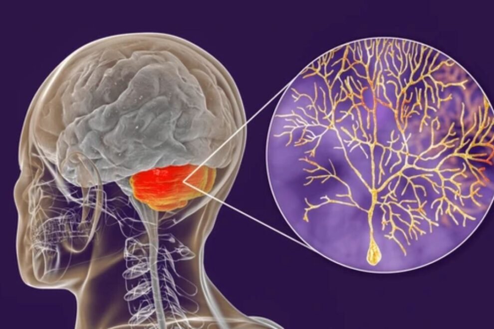 Sensory Atoxia Surgery Sensory Atoxia Surgery