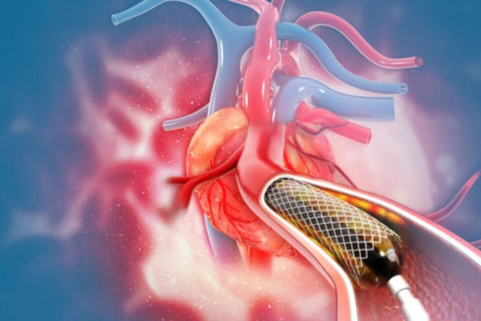 Sensory Ataxia Venous Angioplasty Surgery: Procedure, Benefits & Recovery Sensory Ataxia Venous Angioplasty Surgery: Procedure, Benefits & Recovery