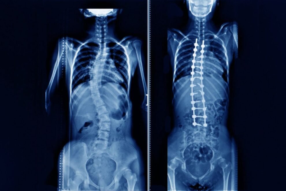 Spinal Fusion with Decompression: Advanced Treatment for Spine Disorders in India Spinal Fusion with Decompression: Advanced Treatment for Spine Disorders in India