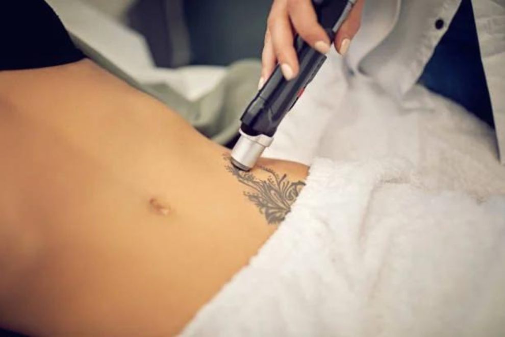 Tattoo Removal in India Tattoo Removal in India