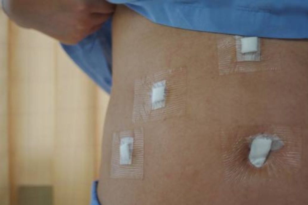 Cholecystectomy Surgery Cholecystectomy Surgery