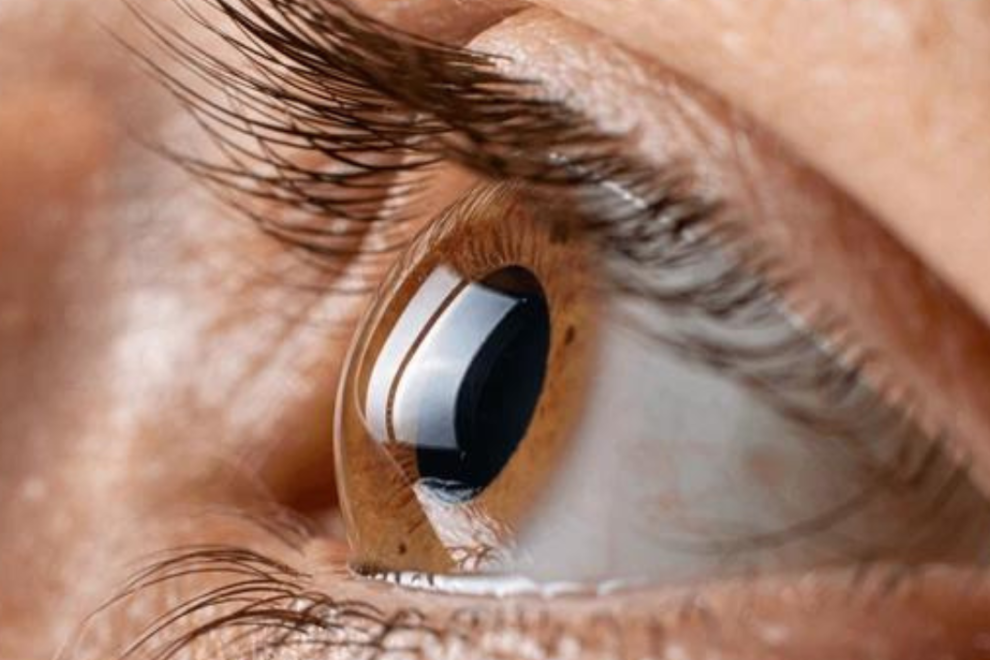 Cornea Transplant Cornea Transplant