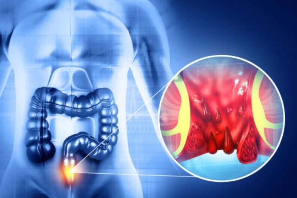 Hernia Mesh Surgery in India Hernia Mesh Surgery in India
