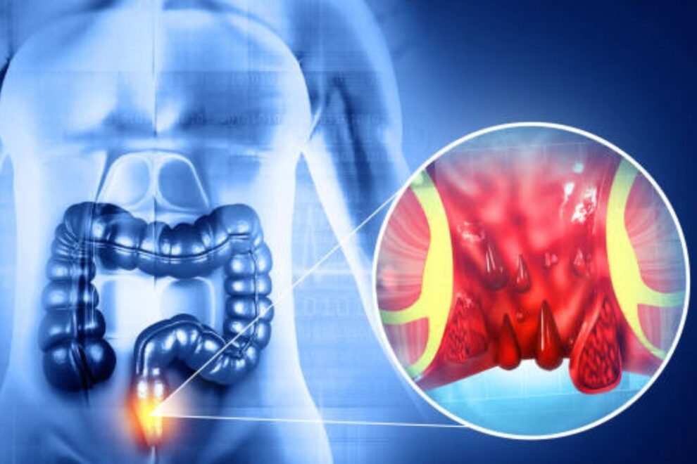 Laparoscopic Hernia Repair Surgery in India: Safe & Effective Treatment Laparoscopic Hernia Repair Surgery in India: Safe & Effective Treatment