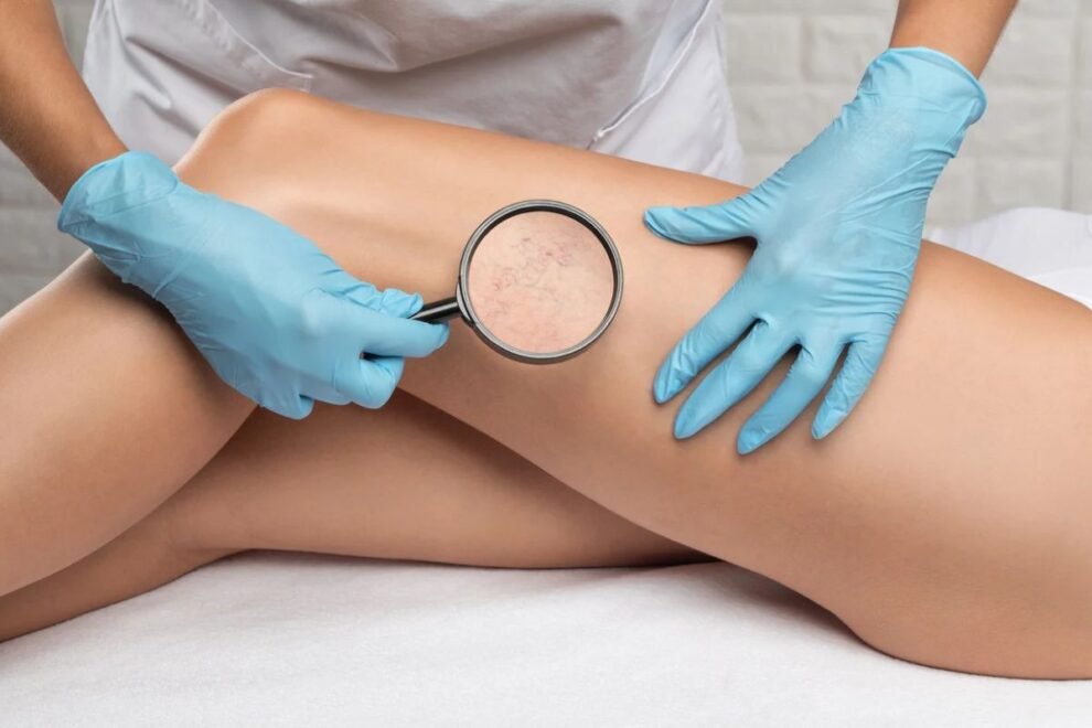 Laser Spider Vein Treatment in India Effective Solutions for Varicose Veins Laser Spider Vein Treatment in India Effective Solutions for Varicose Veins