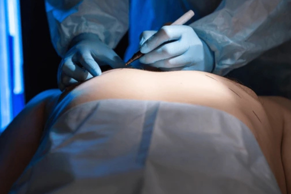 Male Breast Reduction Surgery in india Male Breast Reduction Surgery in india