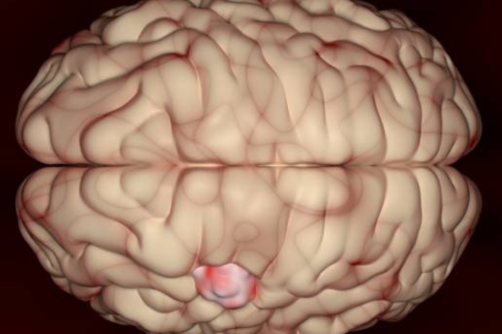Meningiomas in India Meningiomas in India
