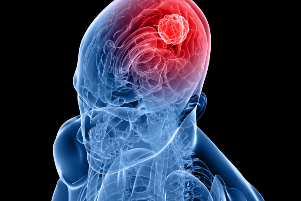 Metastatic brain tumors Metastatic brain tumors