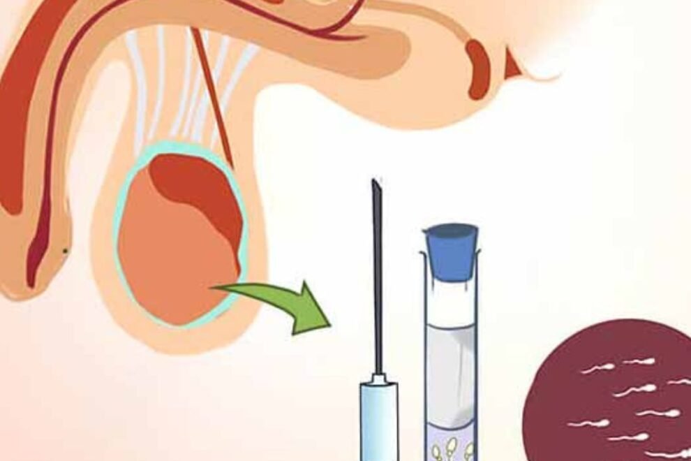 PESA Treatment India: Expert Care for Male Infertility Solutions PESA Treatment India: Expert Care for Male Infertility Solutions