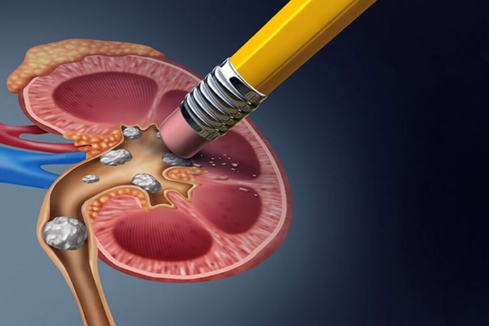 Pcnl Surgery in India: Affordable Kidney Stone Removal Treatment Pcnl Surgery in India: Affordable Kidney Stone Removal Treatment