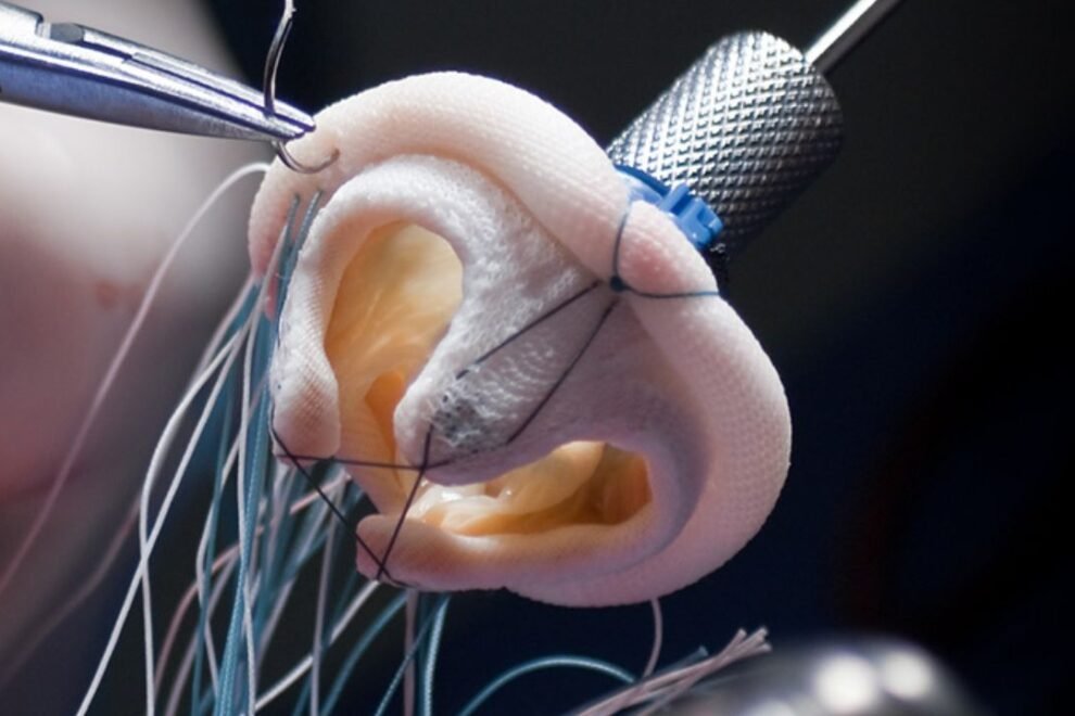 Pediatric Aortic Valve Replacement Repair Surgery in India: Advanced Pediatric Heart Care Pediatric Aortic Valve Replacement Repair Surgery in India: Advanced Pediatric Heart Care