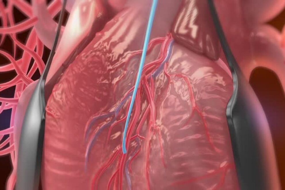 Peripheral Bypass Surgery in India: Cost, Benefits & Top Hospitals Peripheral Bypass Surgery in India: Cost, Benefits & Top Hospitals