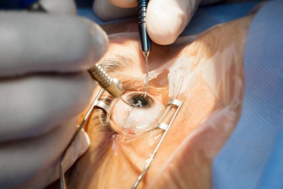 Phacoemulsification in India: Advanced Cataract Surgery Techniques Phacoemulsification in India: Advanced Cataract Surgery Techniques