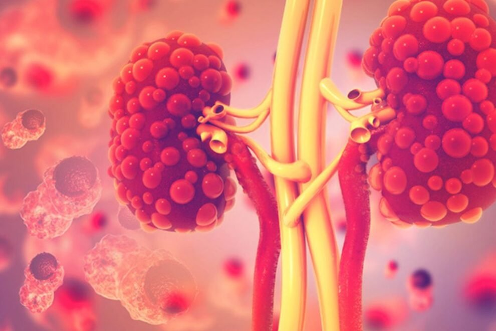 Polycystic Kidney Disorder Treatment in India: Effective Solutions & Care Polycystic Kidney Disorder Treatment in India: Effective Solutions & Care