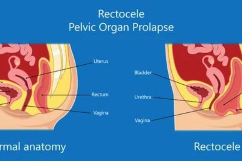 Rectal Prolapse Surgery: Symptoms, Treatment Options, and Recovery Rectal Prolapse Surgery: Symptoms, Treatment Options, and Recovery