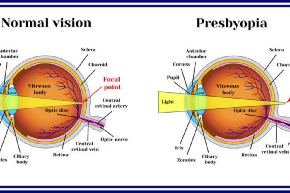 Refractive Errors in India: Causes, Symptoms, and Advanced Treatment Options Refractive Errors in India: Causes, Symptoms, and Advanced Treatment Options
