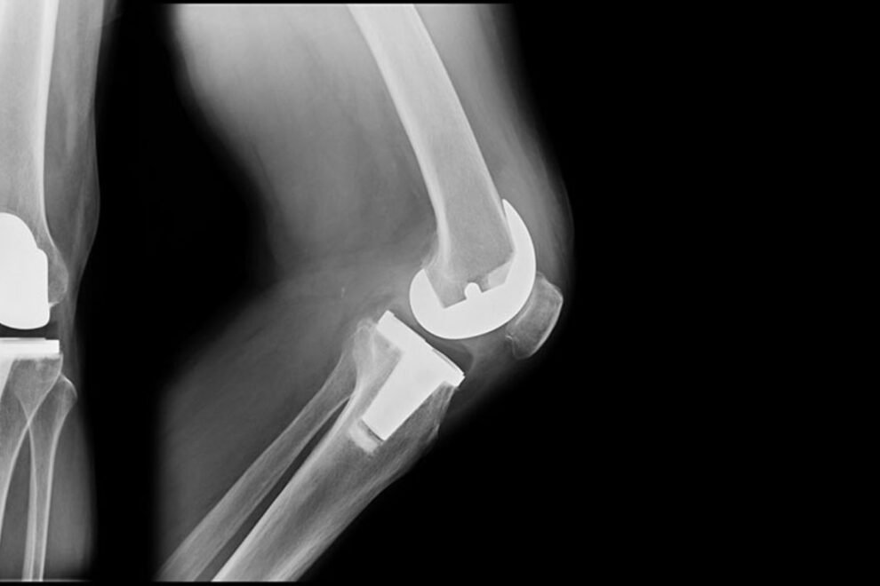 Bilateral Knee Replacement Surgery in India Bilateral Knee Replacement Surgery in India