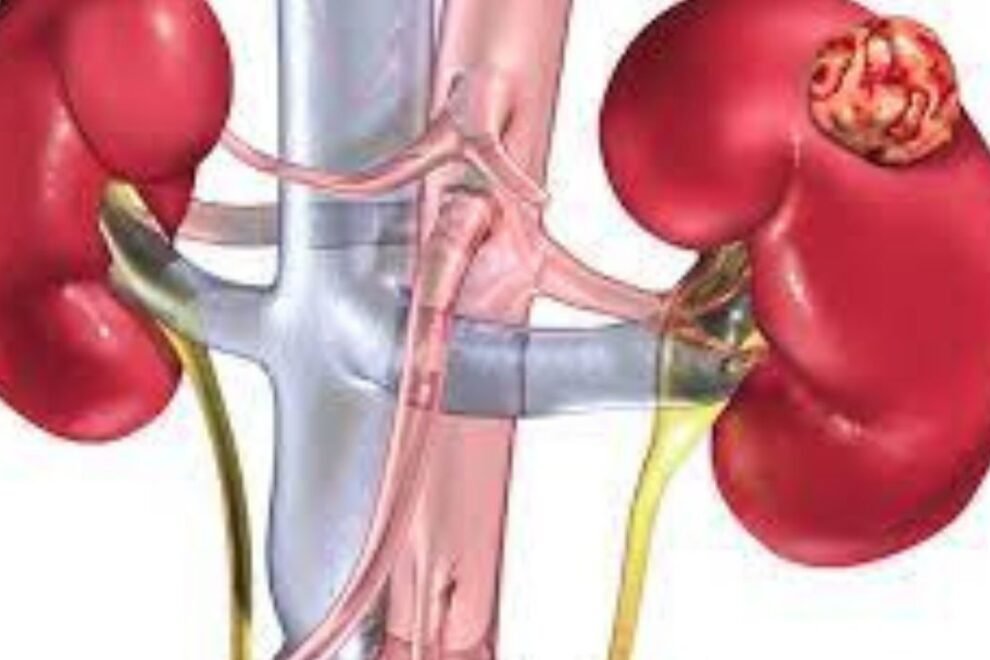 Kidney Cancer Treatment in India Advanced Oncolog Kidney Cancer Treatment in India Advanced Oncolog