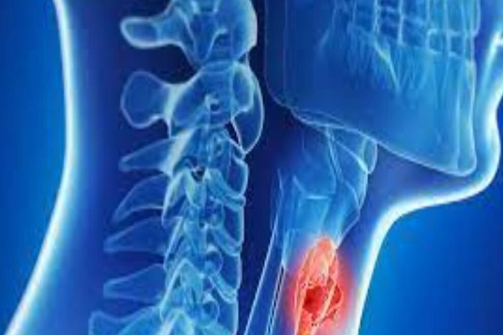 Thoracic Cancer Treatment in India